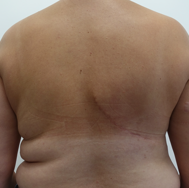 After - back scar